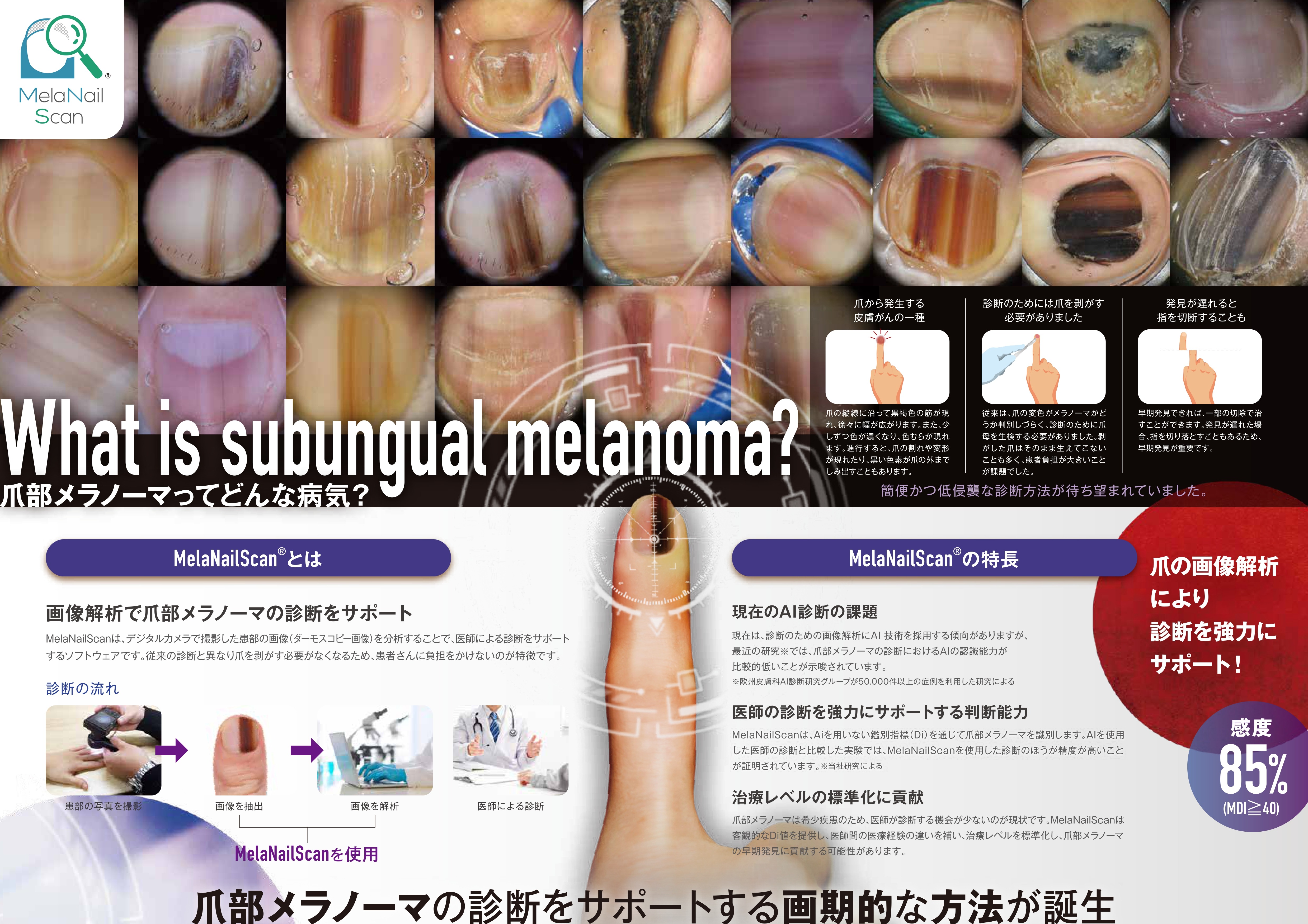爪部メラノーマってどんな病気？