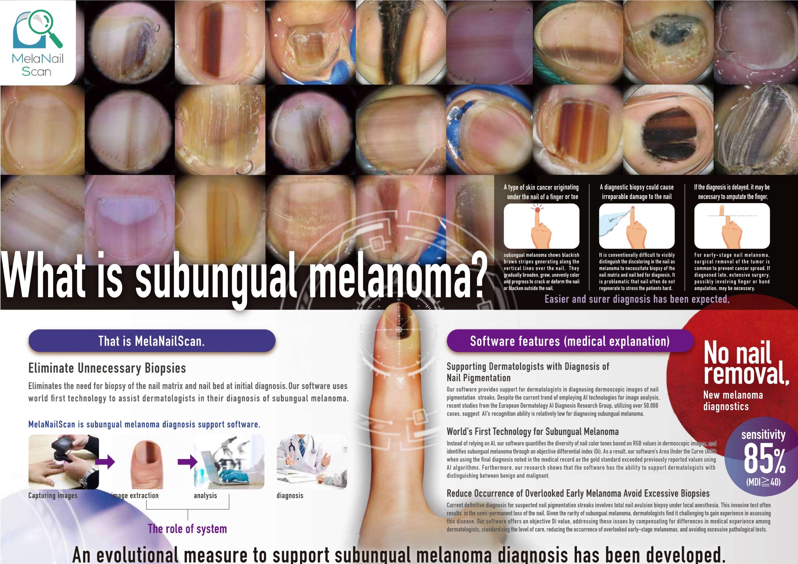 What is subungual melanoma?